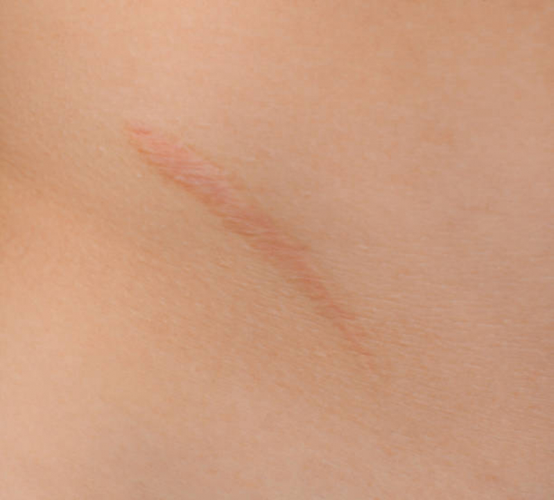Clinica Especializada em Tratamento Cicatriz Acne Sanvitto - Tratamento a Laser para Cicatriz