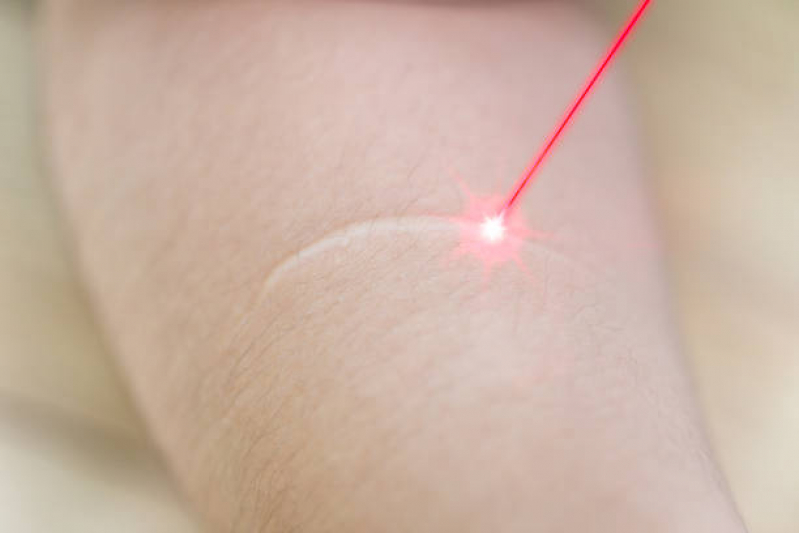 Clinica Especializada em Tratamento de Cicatrizes Armação do Pântano do Sul - Tratamento a Laser para Cicatriz