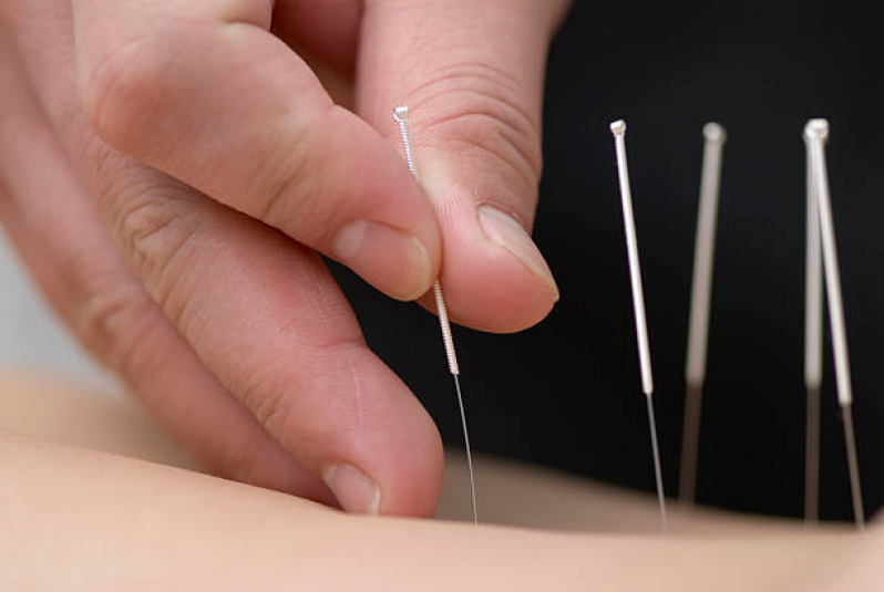 Clínica Que Faz Acupuntura Auricular Anchieta - Acupuntura Porto Alegre