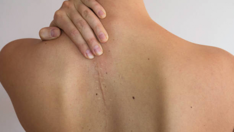 Clínica Que Faz Tratamento a Laser para Cicatriz Camaquã - Tratamento para Cicatrizes