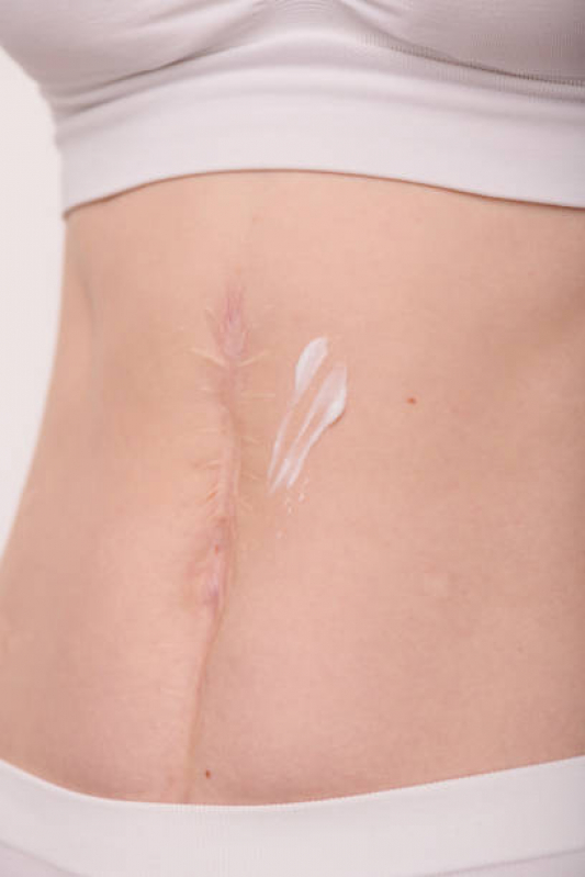Clínica Que Faz Tratamento para Cicatriz Hipertrófica Santa Tereza - Tratamento a Laser para Cicatriz