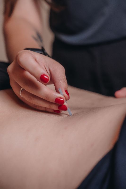 Onde Fazer Acupuntura para Hernia de Disco Mata da Praia - Acupuntura para Coluna Lombar Porto Alegre