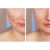 clínica que faz tratamento cicatriz acne Encosta do Sol