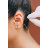 onde fazer acupuntura orelha Asunção