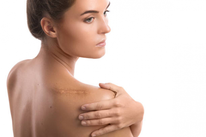 Tratamento a Laser para Cicatriz Fiuza - Tratamento para Marcas de Acne