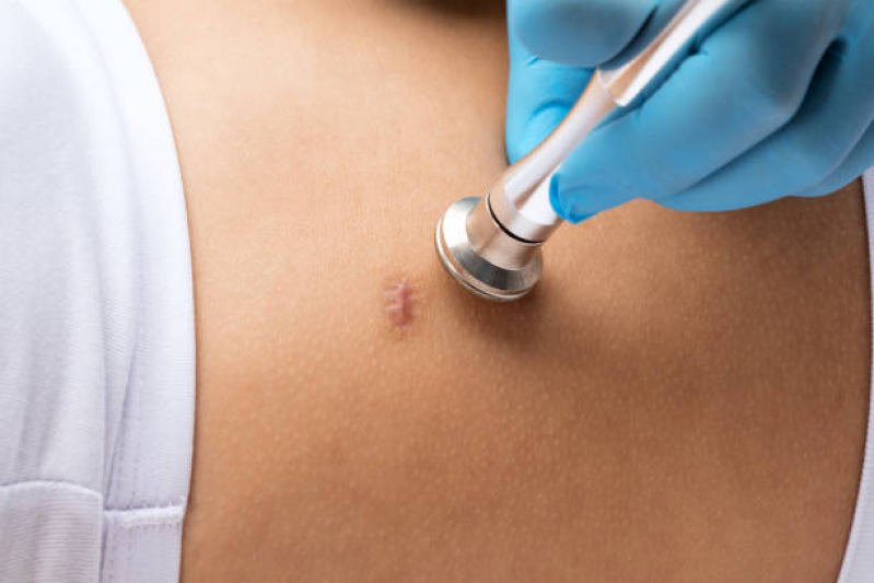 Tratamento Cicatriz Hipertrófica Agendar Areal - Tratamento para Cicatriz de Acne
