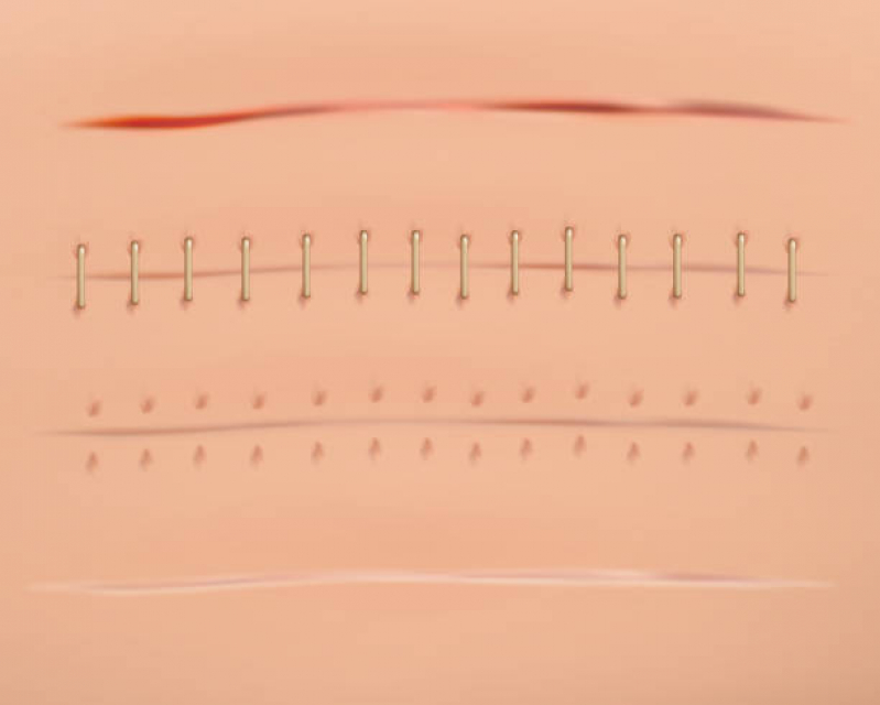 Tratamento Cicatriz Hipertrófica Marcar Vila João Pessoa - Tratamento a Laser para Cicatriz