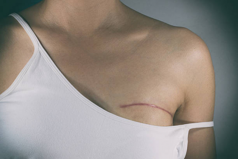 Tratamento de Cicatrizes Agendar Vila Ipiranga - Tratamento a Laser para Cicatriz