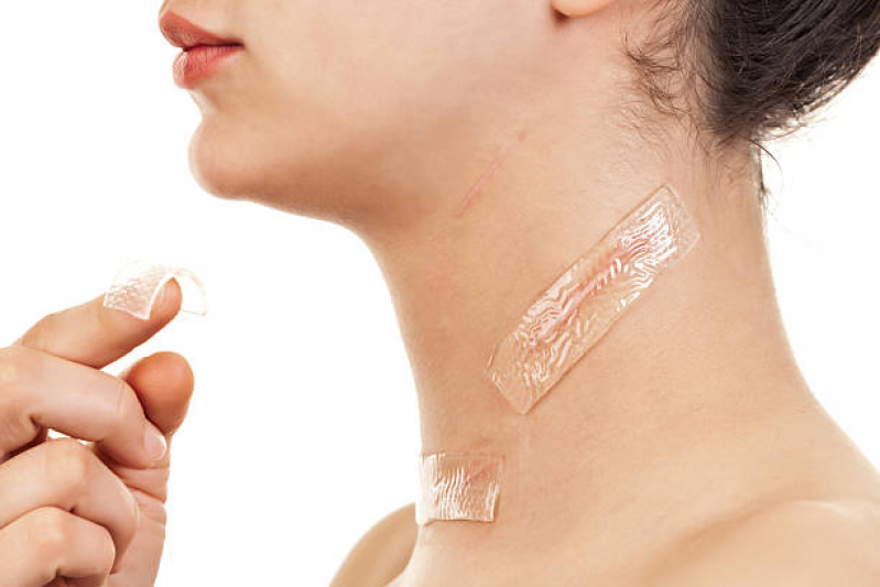 Tratamento Marcas de Acne Linha Olinda - Tratamento para Cicatrizes de Cirurgia