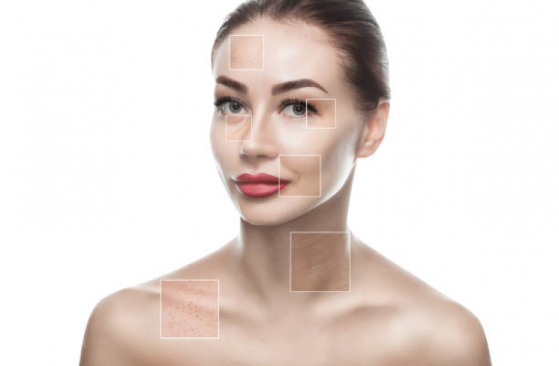 Tratamento para Marcas de Acne Belém Velho - Tratamento a Laser para Cicatriz