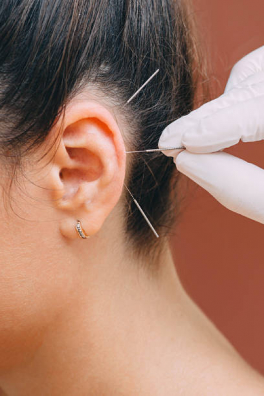 acupuntura-orelha