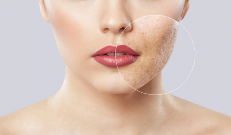 tratamento-de-cicatriz-de-acne